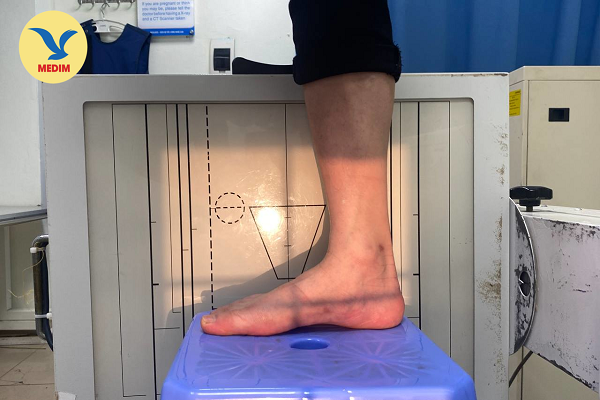 Chụp X quang bàn chân bẹt